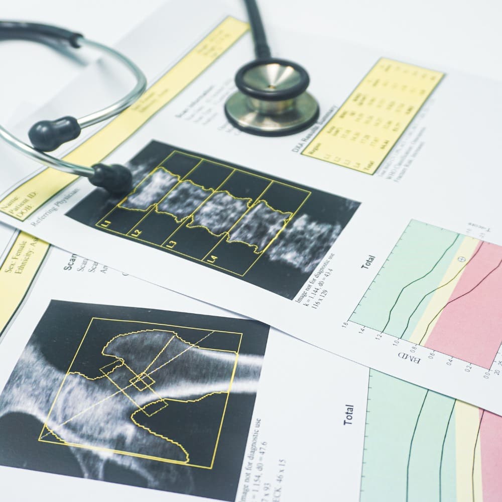 Bone Density Testing